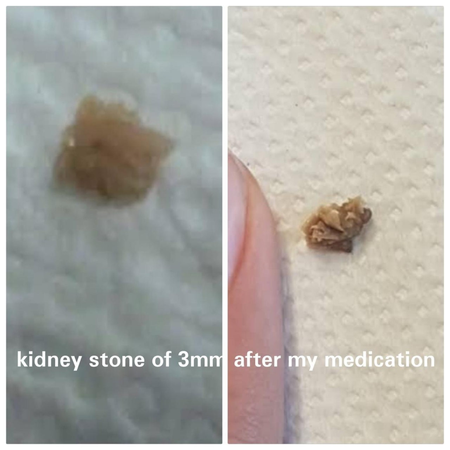 Acne and Pimple Treatment Before After