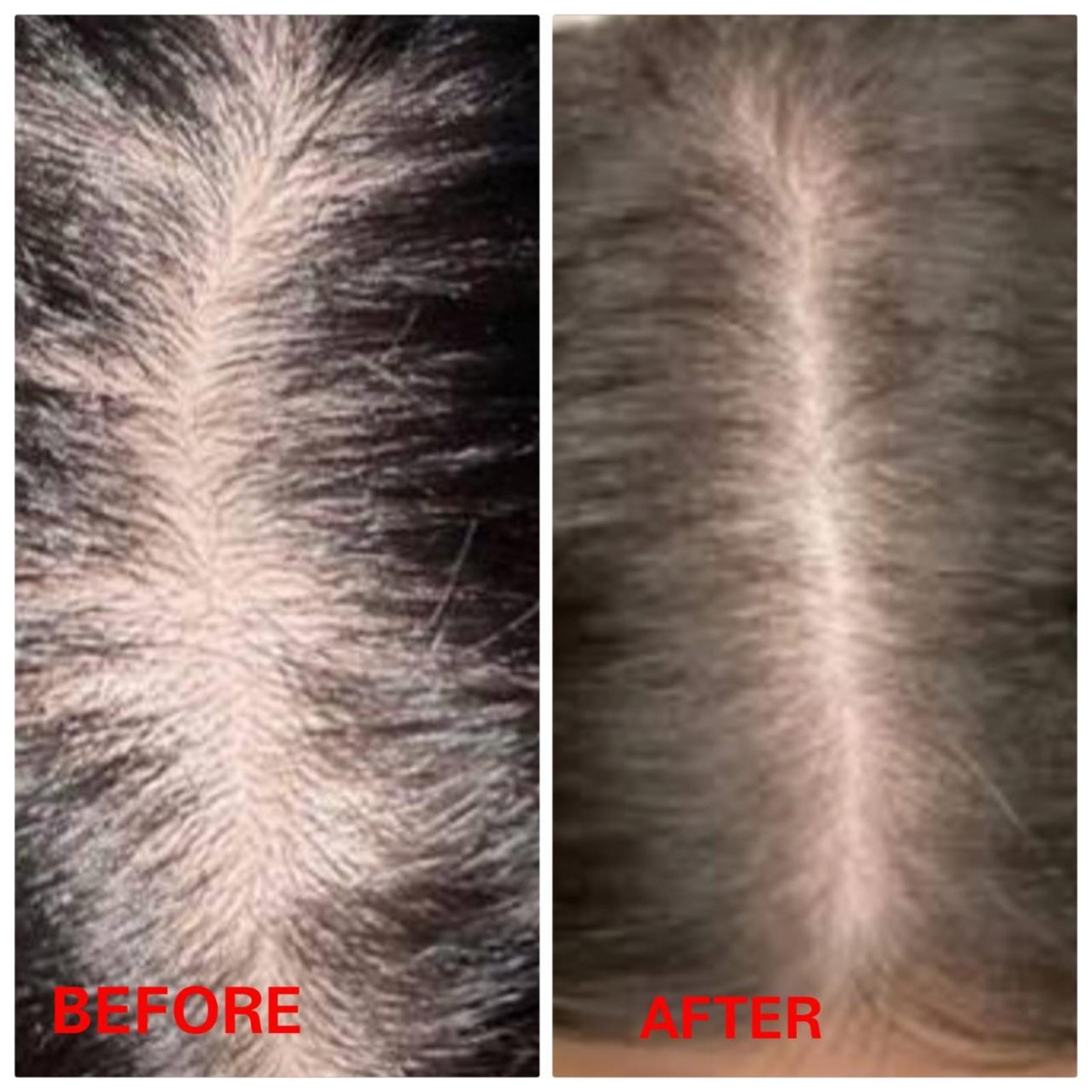 Dark Neck Pigmentation Correction
