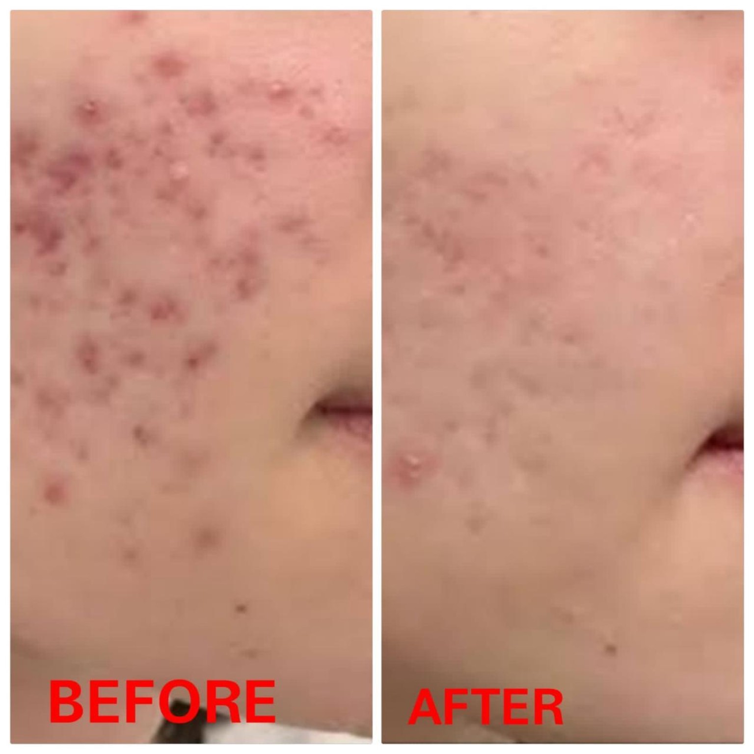 Acne Marks Healing Progress