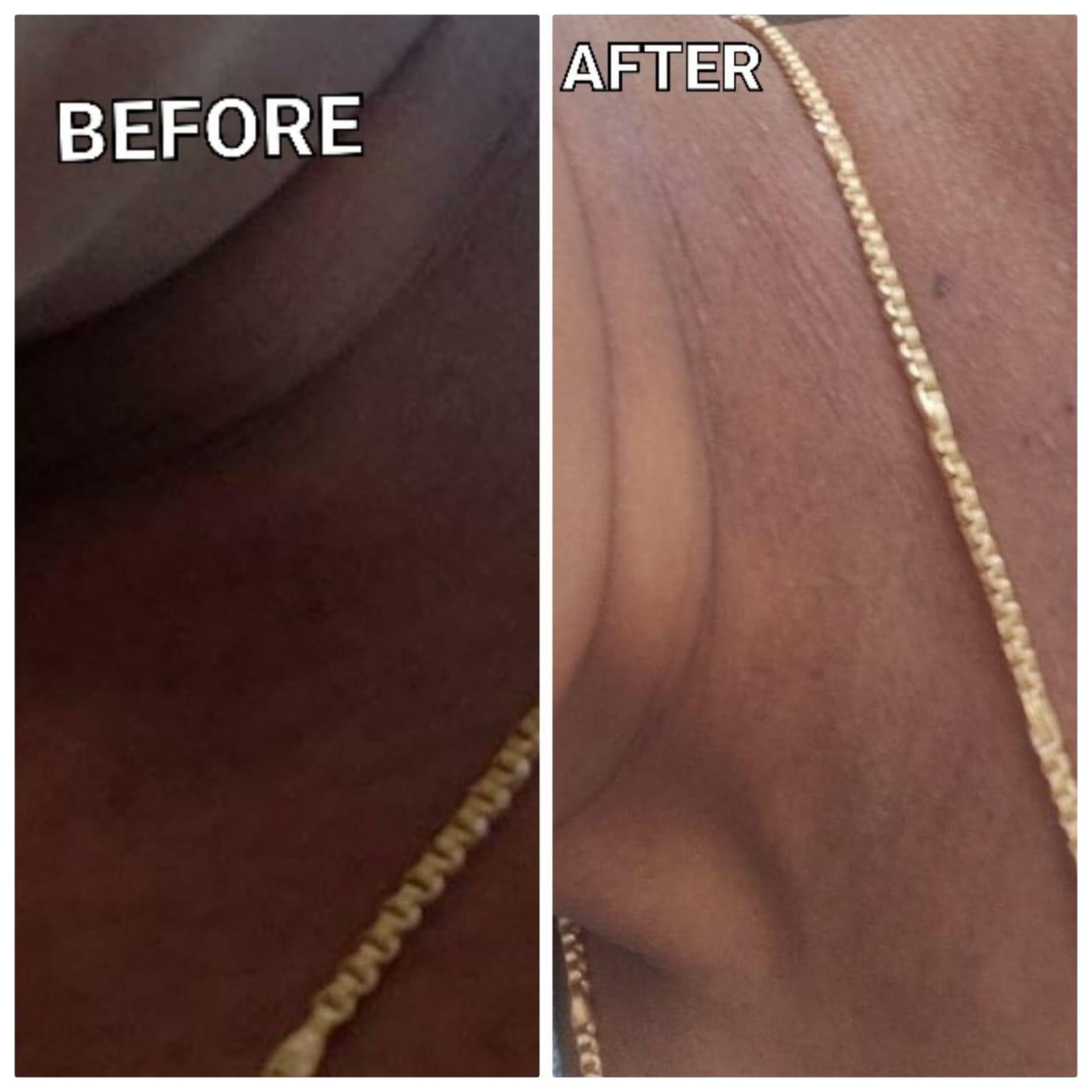 Complexion Correction Treatment Result - SS Homeo Clinic Hyderabad