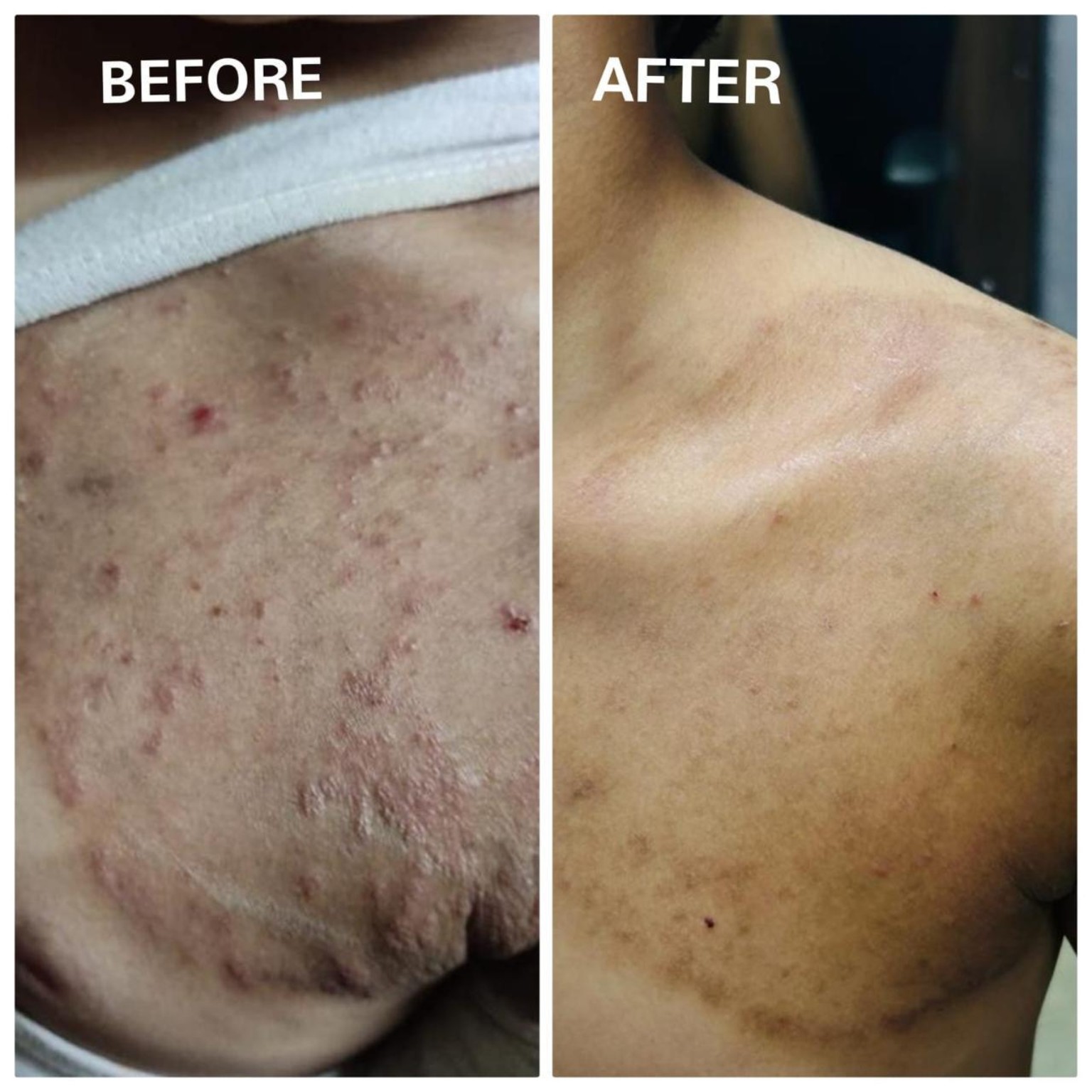 Eczema Treatment Result Before and After - SS Homeo Clinic Hyderabad