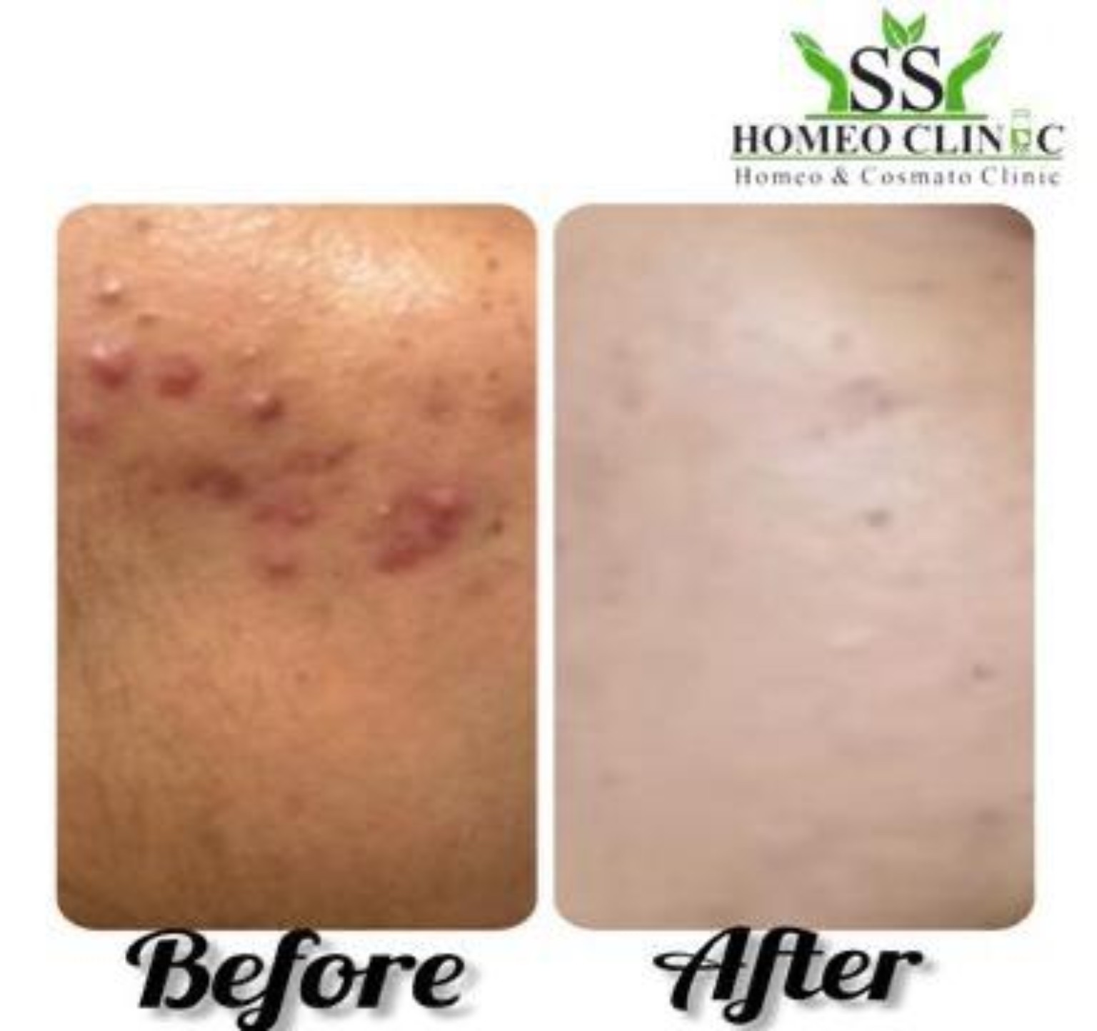 Warts Removal Homeopathy Success