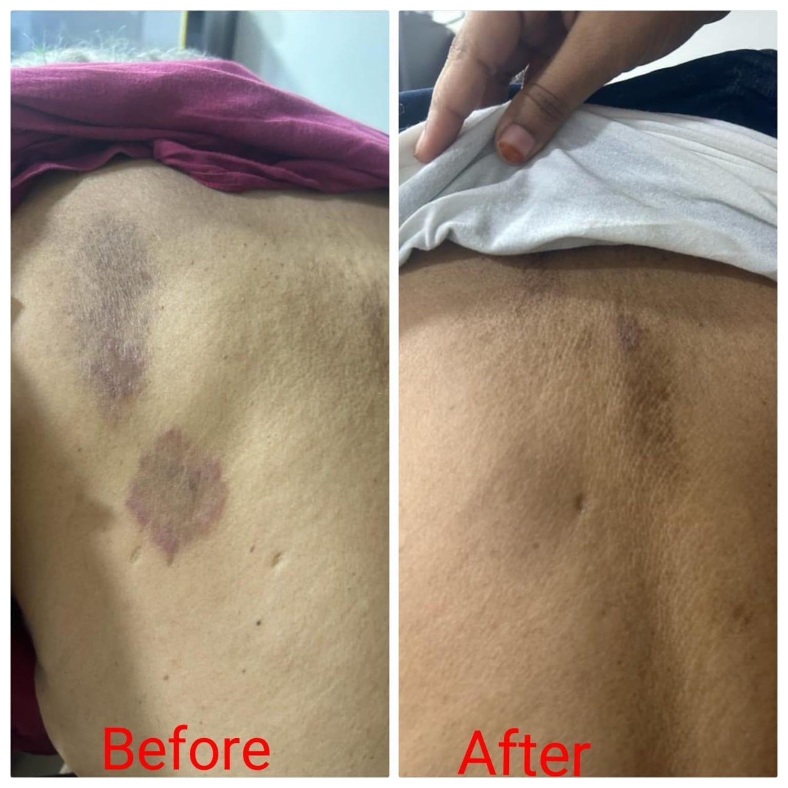 Vitiligo and Leucoderma Healing Result