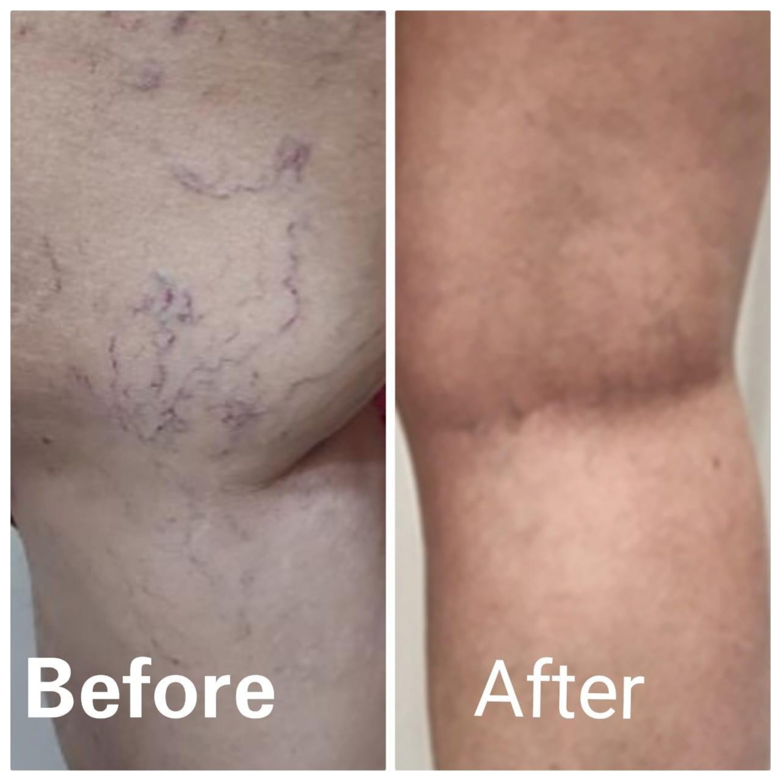 Nail Fungal Infection Psoriasis Care