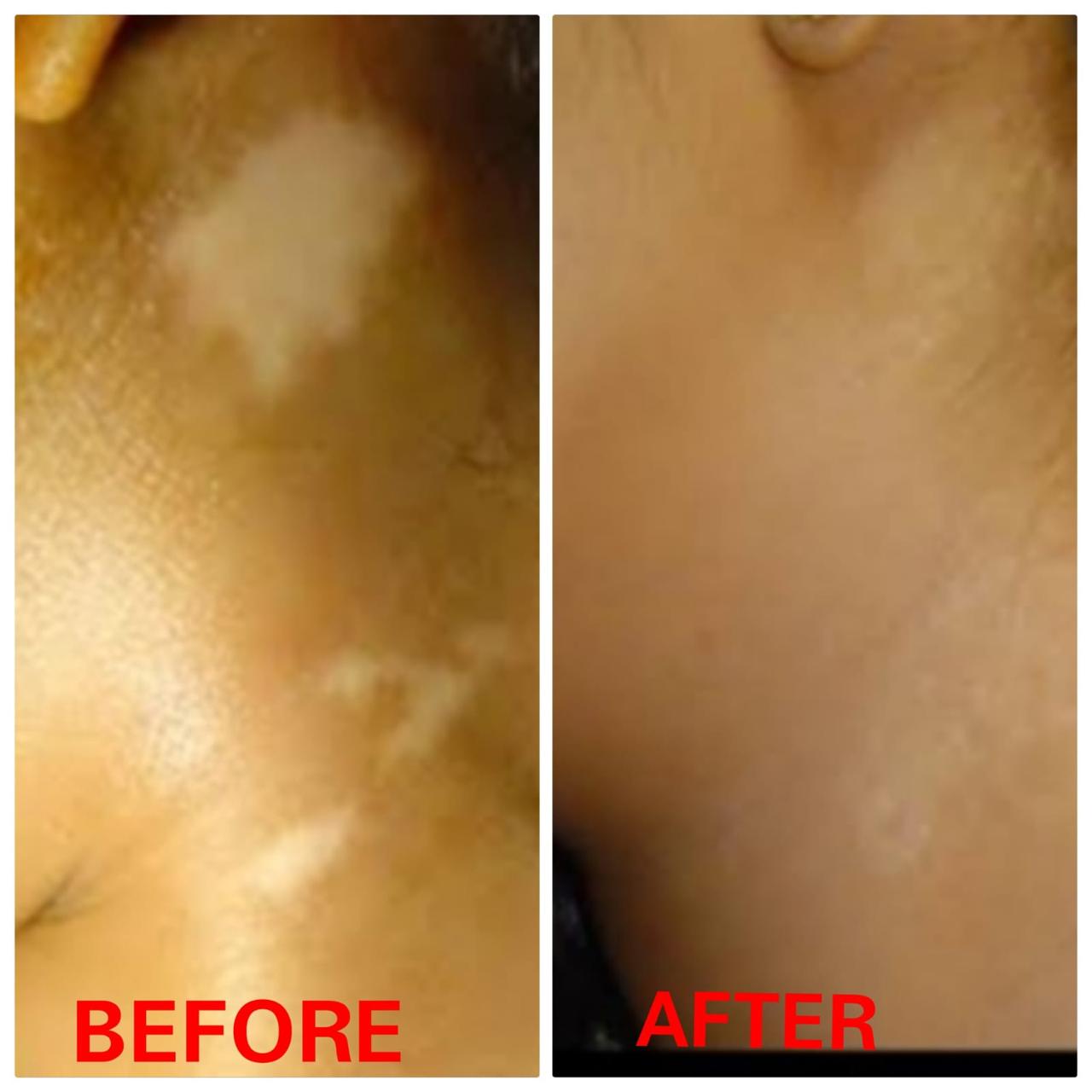 Leucoderma Treatment Result Before and After - SS Homeo Clinic Hyderabad