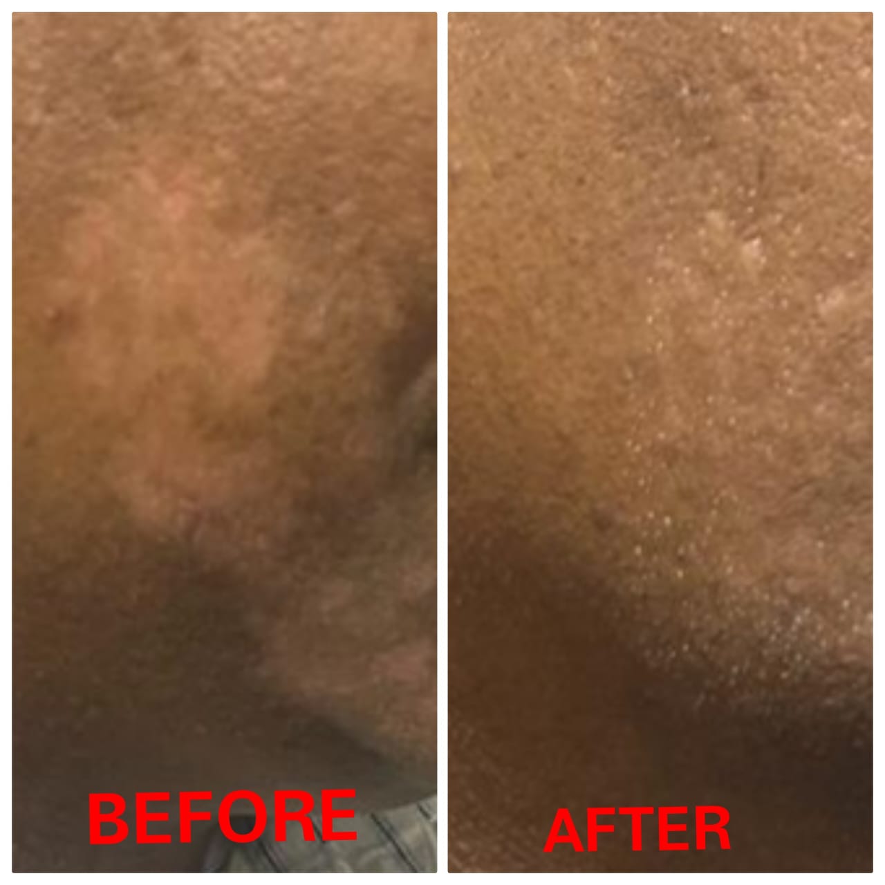 Vitiligo Treatment Result Before and After - SS Homeo Clinic Hyderabad