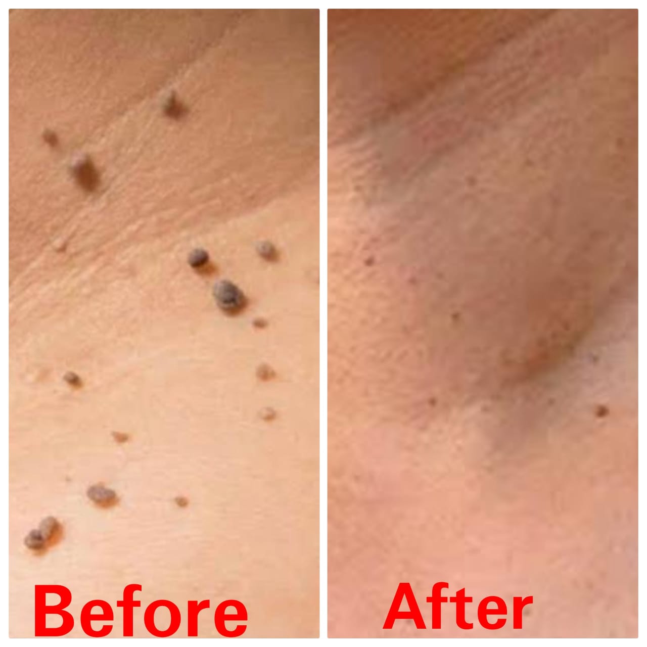 Warts Removal Treatment Result Before and After - SS Homeo Clinic Hyderabad