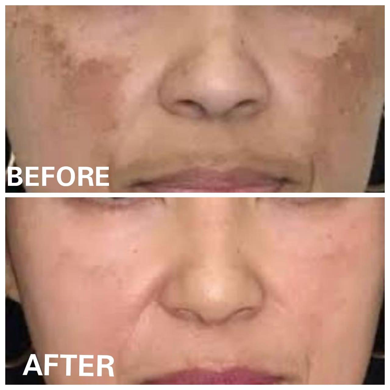 Melasma and Chloasma Treatment Result Before and After - SS Homeo Clinic Hyderabad
