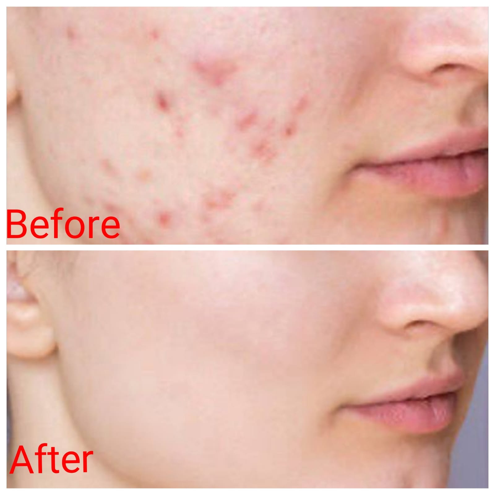 Pimple Treatment Result Before and After - SS Homeo Clinic Hyderabad