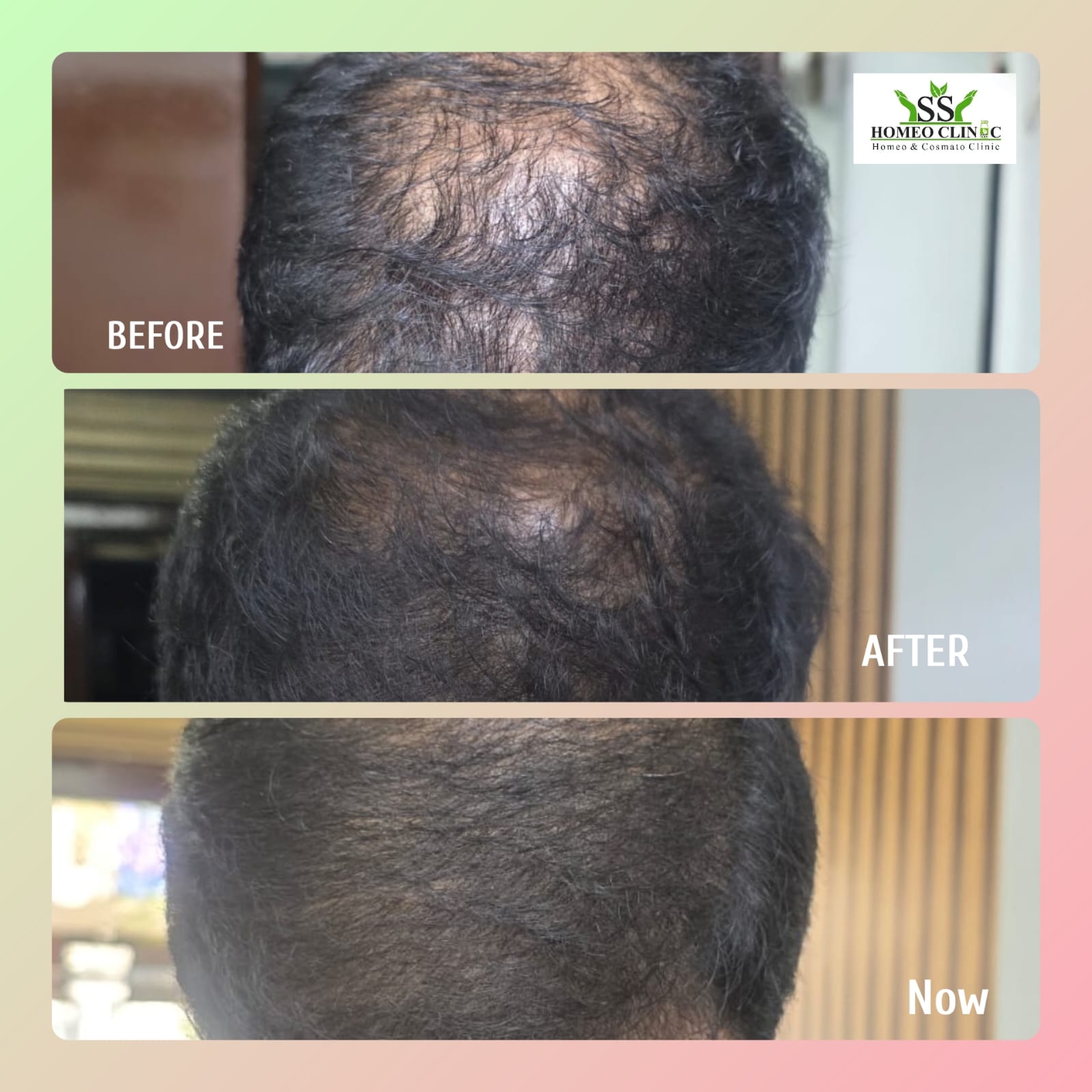 Alopecia Areata Treatment Result Before and After - SS Homeo Clinic Hyderabad